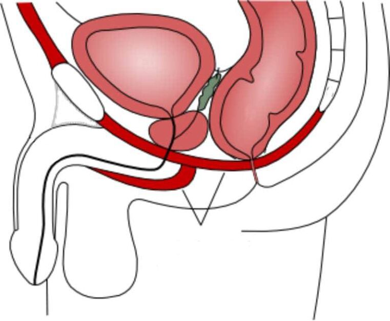 pagsasanay sa pelvic floor muscles upang mapabuti ang potency